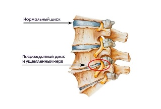 Сімптомы шыйнага астэахандрозу